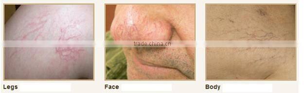 professional diode laser blood vessels removal spider vein / vascular removal equipment