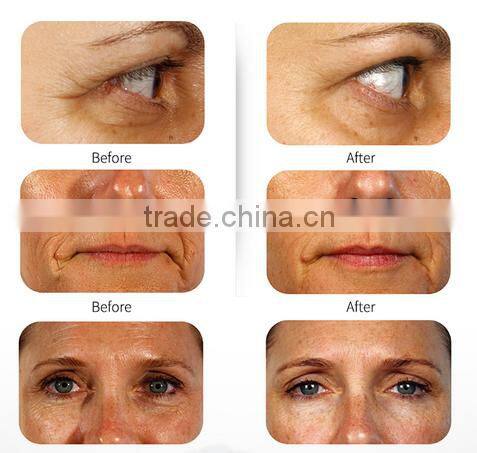 Acne treatment blue light blackhead removal anti age face machine