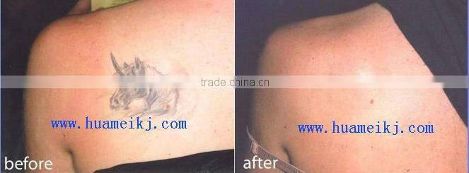 professional tattoo removal machine Nd yag laser