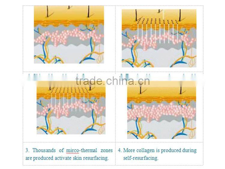 Professional fractional co2 laser/medical laser co2 fractional with CE