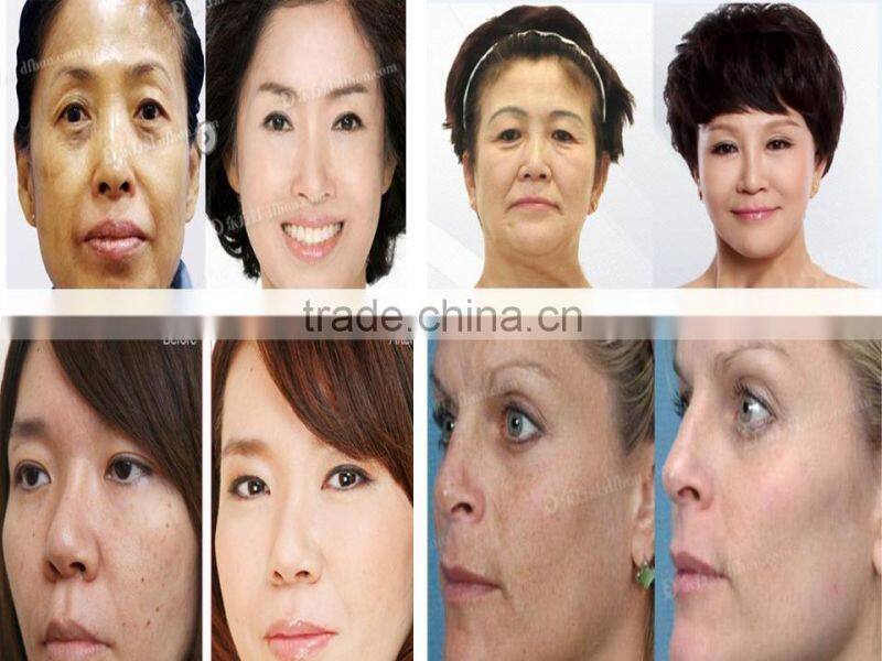 best selling products yag q-switched medical tattoo remove machine with CE certificate D003