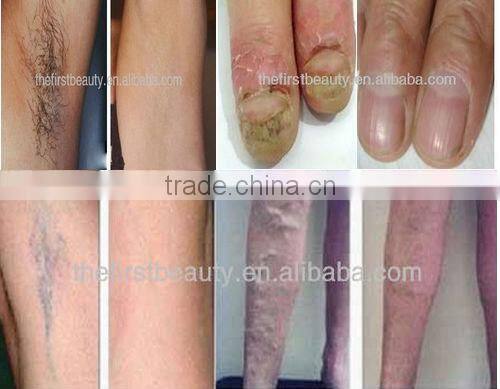 Long pulse nd yag laser toenail fungus laser machine