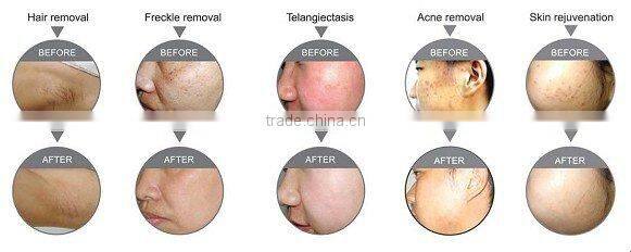 2000W Elight removal acne