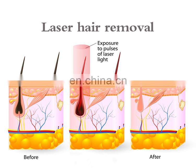 2019 RENLANG Painless laser hair removal /808 fiber coupled diode laser /laser hairline removal