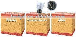 VY-800 Manufacturer micro crystal dermabrasion machine