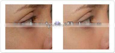 Hot!! Newest and best effective Beauty salon equiment for skin rejuvenation