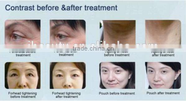2015 Most Popular Lift Eyes&Brows Remove Crows Feet & Pouches High Intensity Focused Ultrasound Hifu