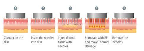 5Mhz Bipolar facial skin tightening devices