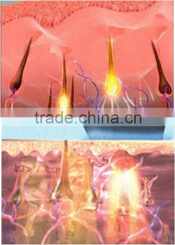 Pain-free Depilation Device hair removal SHR IPL