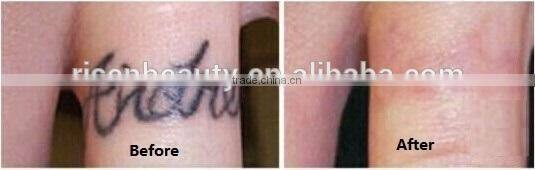 Best Price Q Switch Tattoo Removal laser for sale