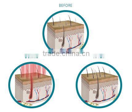 laser helmet for hair regrowth/hair regrowth laser machine
