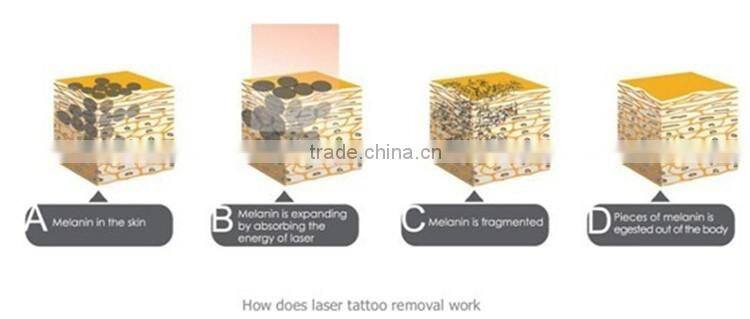 1064 532nm pigmentation removal tatoo removal nd yag laser machine prices