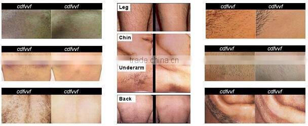 Permanently hair removal !! 3000W SHR palomar ipl laser