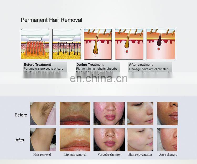 Ready to ship double handles shr elight portable machine for sale
