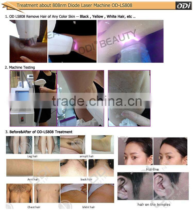 Bestselling cheap laser hair remover diode laser system OD-LS808
