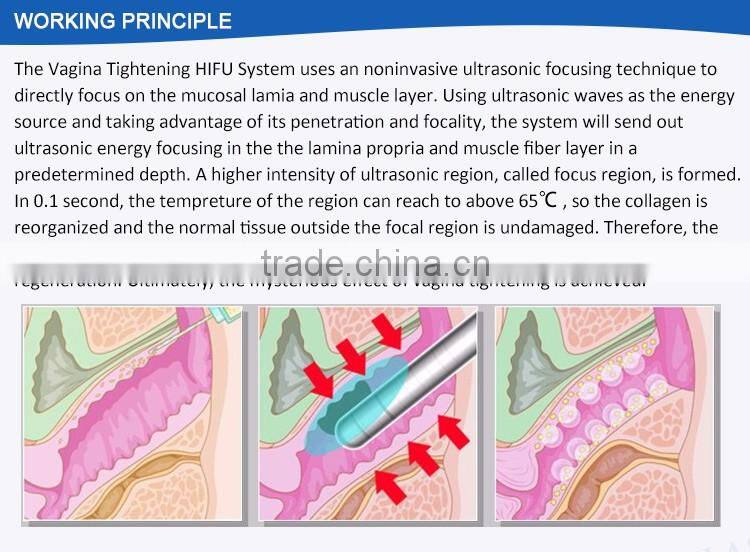 2017 Newest innovative technology private tighten HIFU handpiece sex vaginal tightening cream