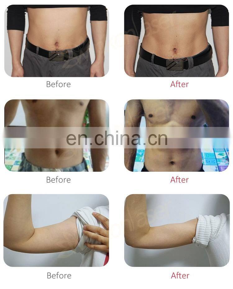 2 Handles 4 handles ems electromagnetic muscle stimulation electromagnetic tesla ems muscle