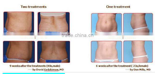 Lipo Freeze Fat equipment For Home/weight Loss Machine/rf DRX-C26