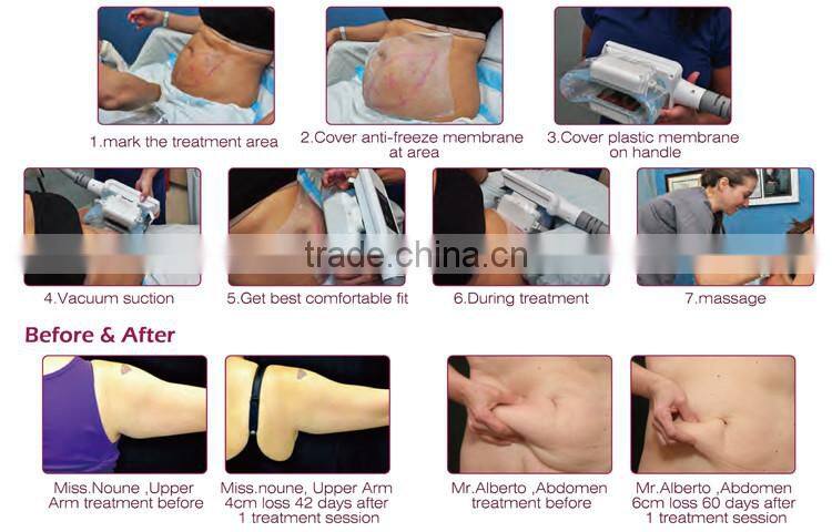 Multi size 60g 70g 75g 110g protective membrane criolipolisis for sale