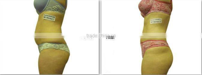 2016 hot sale Cryotherapy 40K ultrasonic cavitation weight loss Radio frequency Cryolipolysis Fat Freeze Slimming Machine for Sa