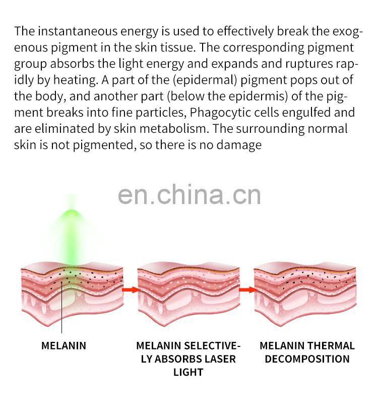 Q Switch ND Yag Laser Machine Non Invasive Tattoo Removal Laser Machine Freckle Eyebrow Pigment Removal Beauty Instrument