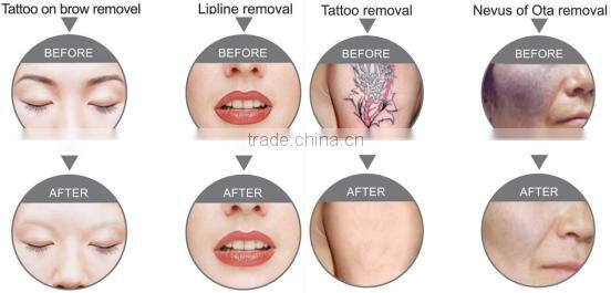 ND yag laser tattoo removal birth mark remover machine q switch nd yag laser machine