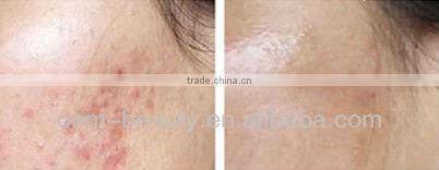 Best cooling system elight ipl rf nd yag laser system