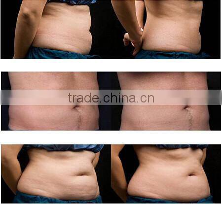Cryo laser weight loss slimming electrotherapy home cryolipolysis beauty salon equipment