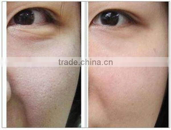 Permanent hair removal machines for skin rejuvenation beauty machine BD-J005