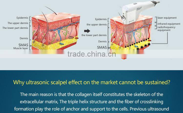 No bleeding face lifting machine home hifu treatment