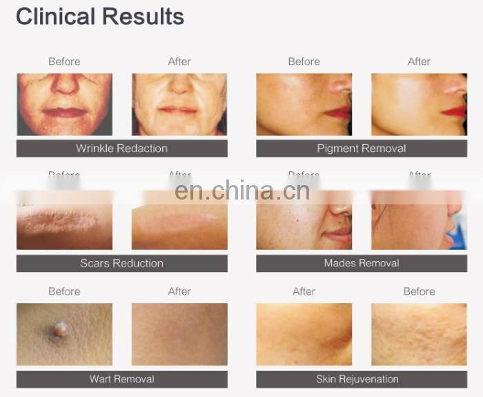 shenzhen gsd tech co. ltd co2 fractional laser machine