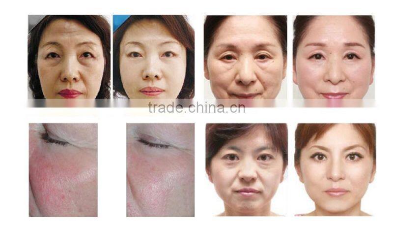 **** 40KHz RF Vacuum Cavitation Slimming Machine Multipolar For Belly Slimming / Face Lifting