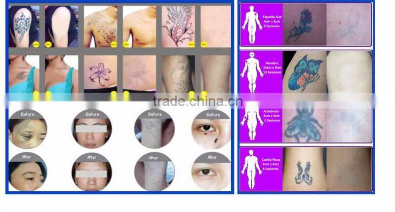 Vertical nd yag pulsed laser/nd yag laser