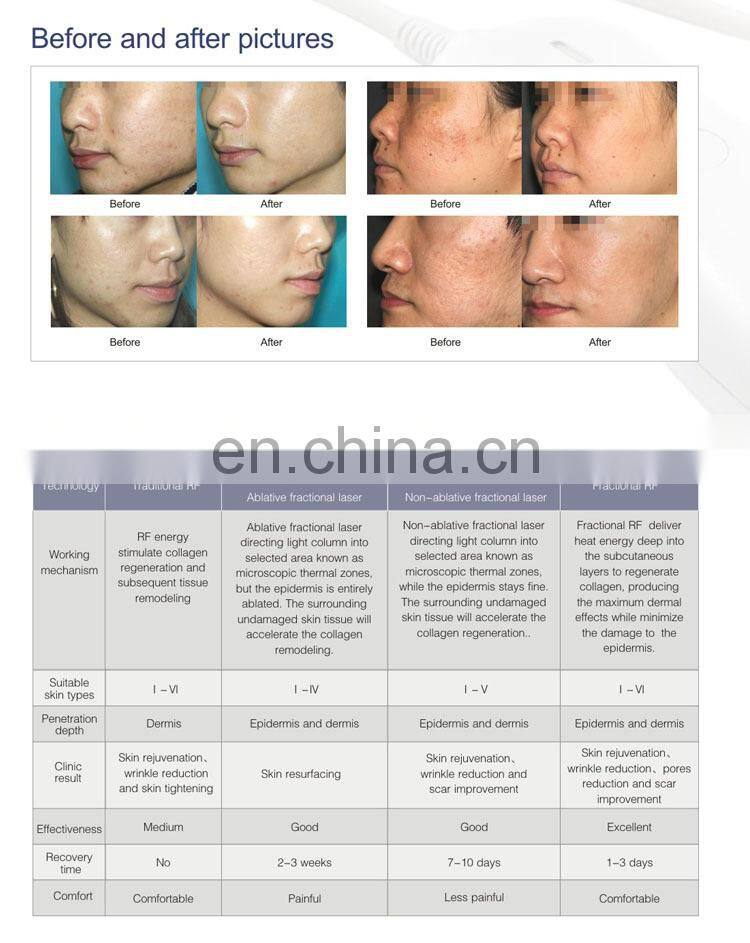 Fractional Micro needle RF Anti aging /scar removal beauty Machine