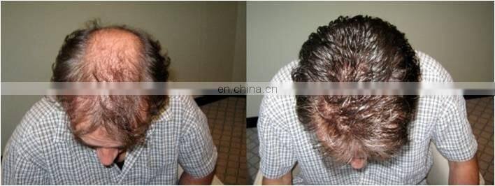 Low level laser hair growth helmets 650nm hair growth led light and Fda