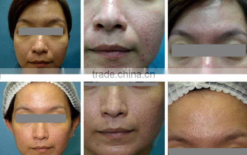 alibaba sales microdermabrasion beauty equipment