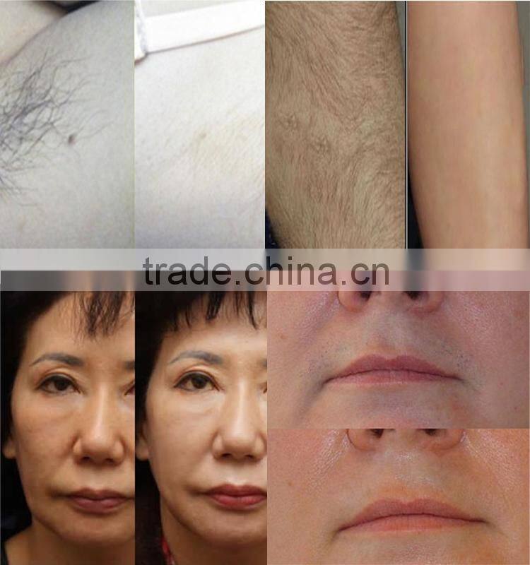 IPL home laser permanent hair removal