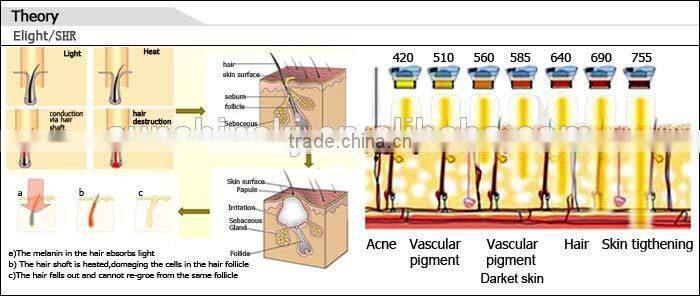 Strong power CE TUV approved 3000w SHR hair removal elight skin rejuvelation ipl italian