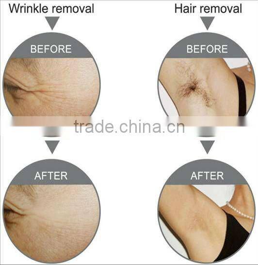 Multifunctional popular ipl elight depilation hair removal