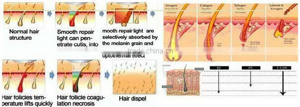 Hot selling!! AFT shr ipl acne treatment equipment/ipl-hair-removal.de