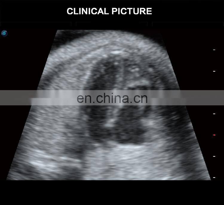 Latest Version Sonoscape P15 Trolley Color Ultrasound machine /cw color doppler ultrasound Sonoscape P15