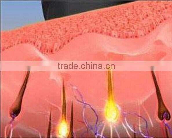 2016 most hot sale super hair removal ipl shr / shr ipl depilation / shr hair removal machine for sale