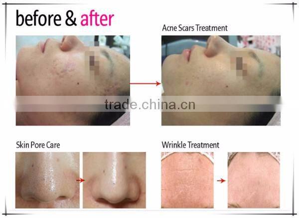 2016 derma rolling system micro needles skin care roller with 1200 needles