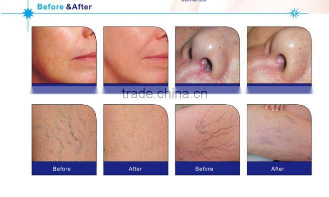 New arrival!!!High frequency 980 diode laser Portable Spider vein/vascular/blood vessels removal machine with Ce approved