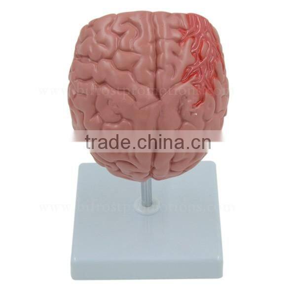 Organs Human Body Anatomy Brain Model Of Stroke
