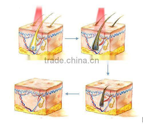 hair removal patent SPT&FCA technology with big spot size aesthetic shr laser machine