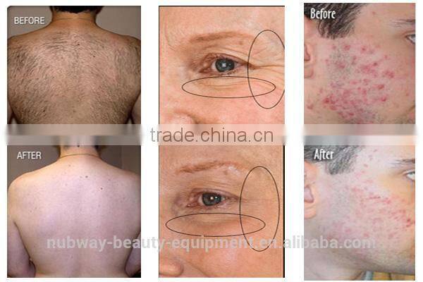 Multifunctional 3 handles radiancy global ipl korea