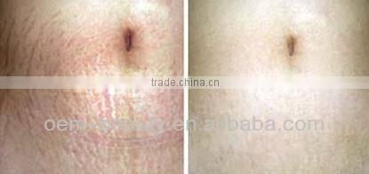 China hot-selling mesotherapy needle machine