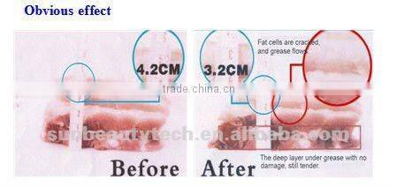 fat cavitation rf and vacuum equipment