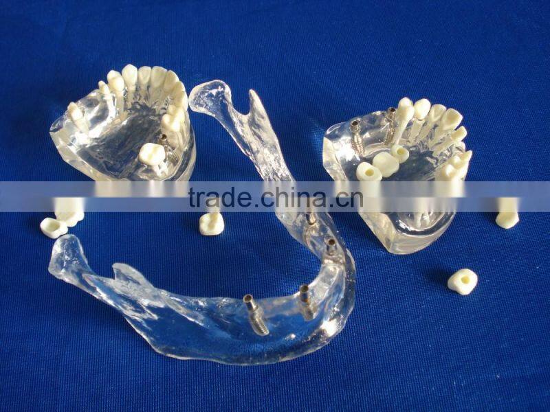 Hot Sale Transparant Mandibule Implant Model